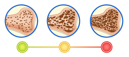 Учёные Сибири и Канады впервые описали остеопороз с точки зрения минералогии